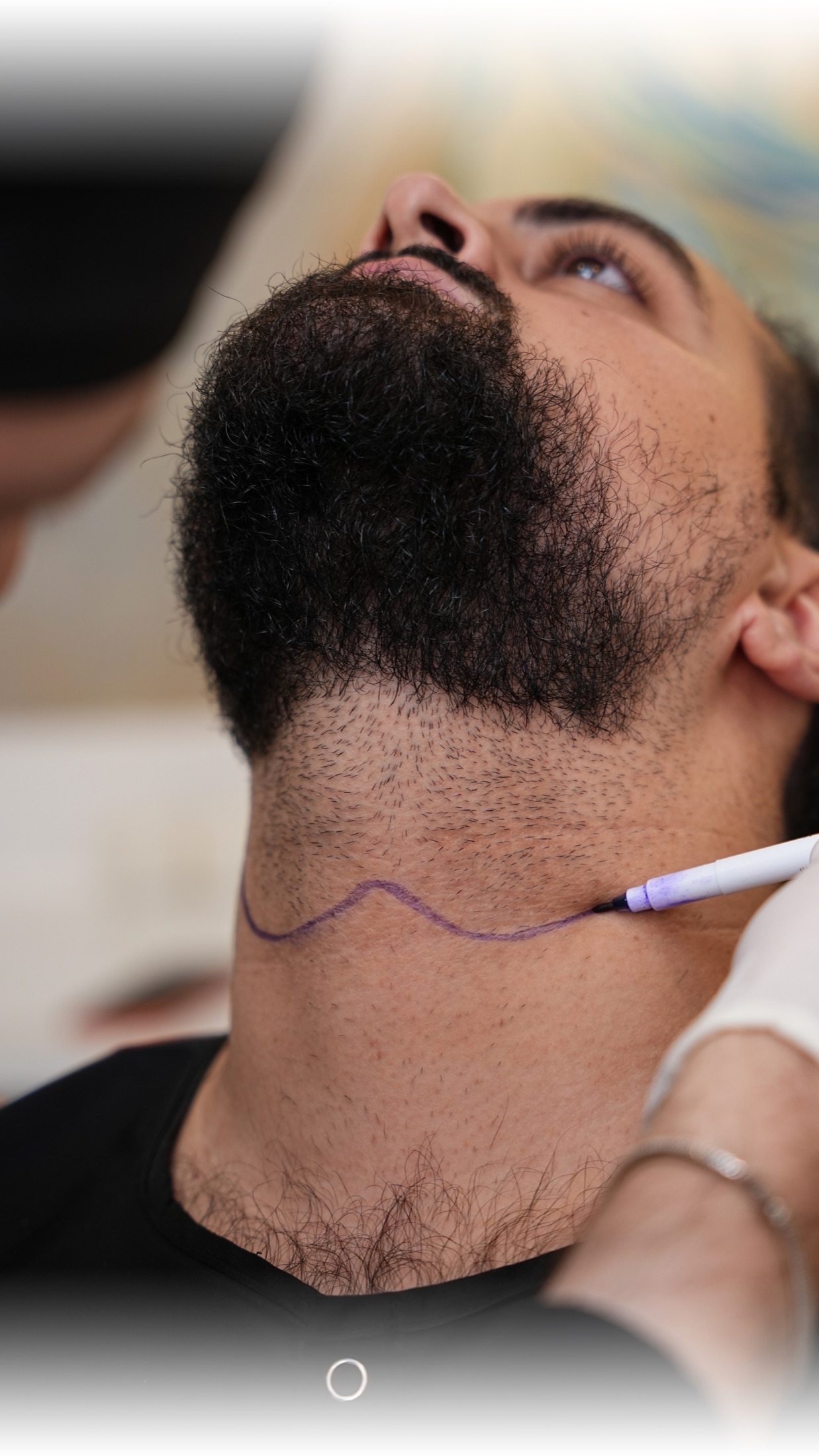 Penandaan area donor janggut di Sule Hair Clinic