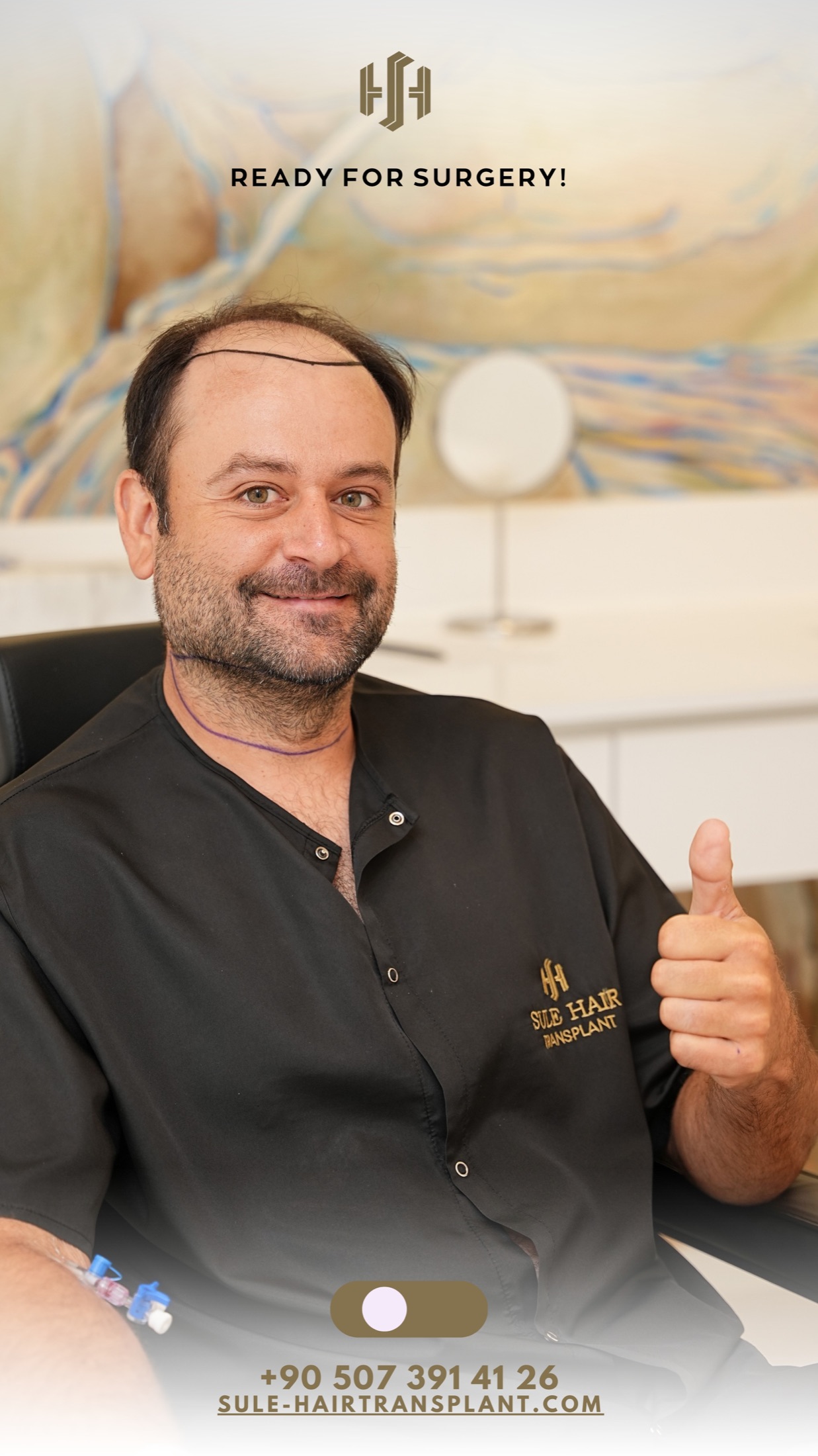 Pasien siap menjalani prosedur donor janggut ke kepala