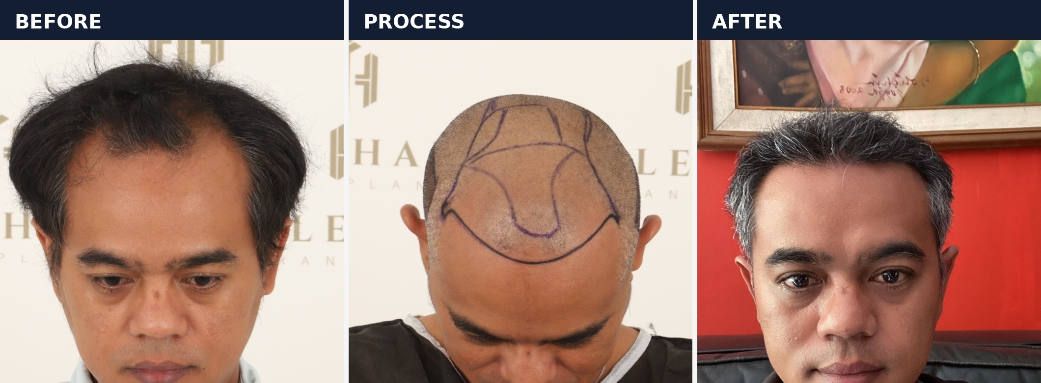 Before process after hasil hair transplant pasien pria di Sule Hair Clinic