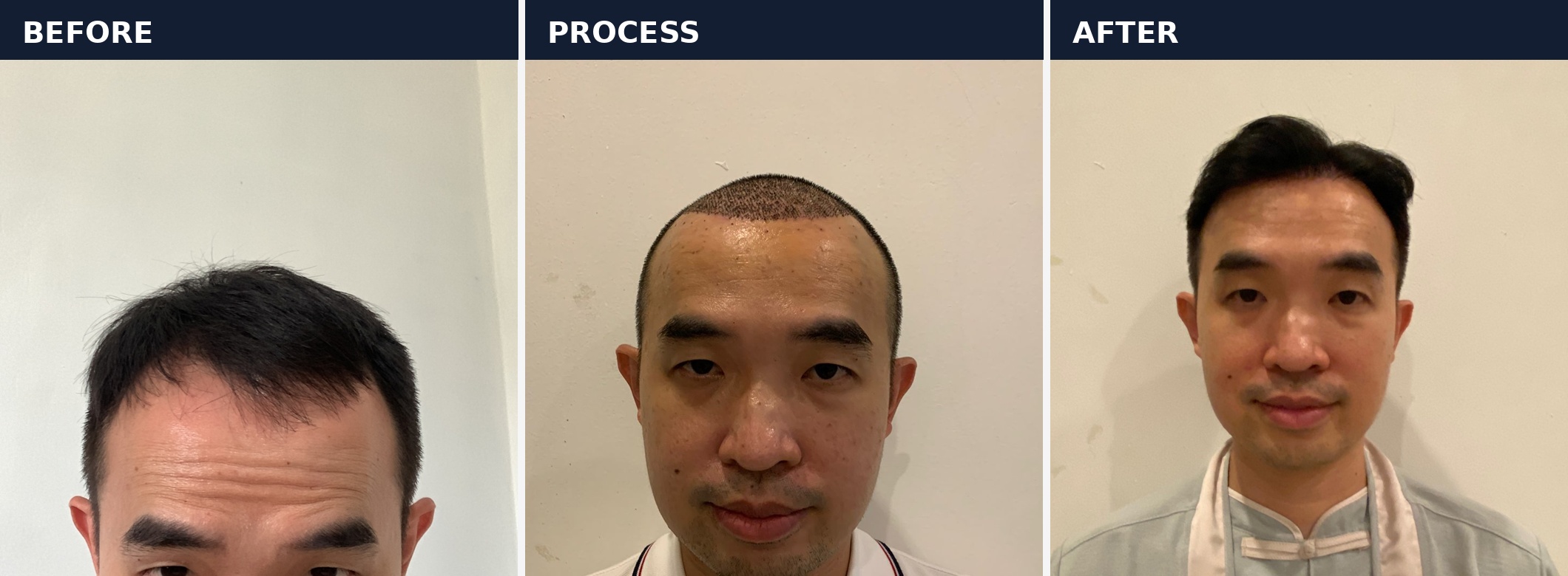 Before process after hasil hair transplant pasien pria Asia di Sule Hair Clinic