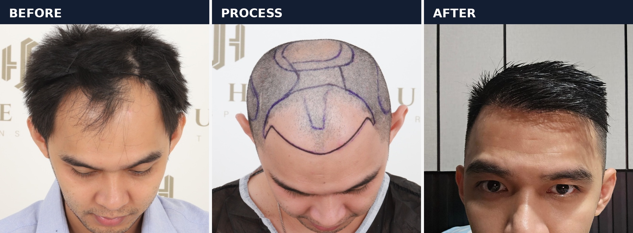 Before process after hasil hair transplant dengan desain hairline di Sule Hair Clinic