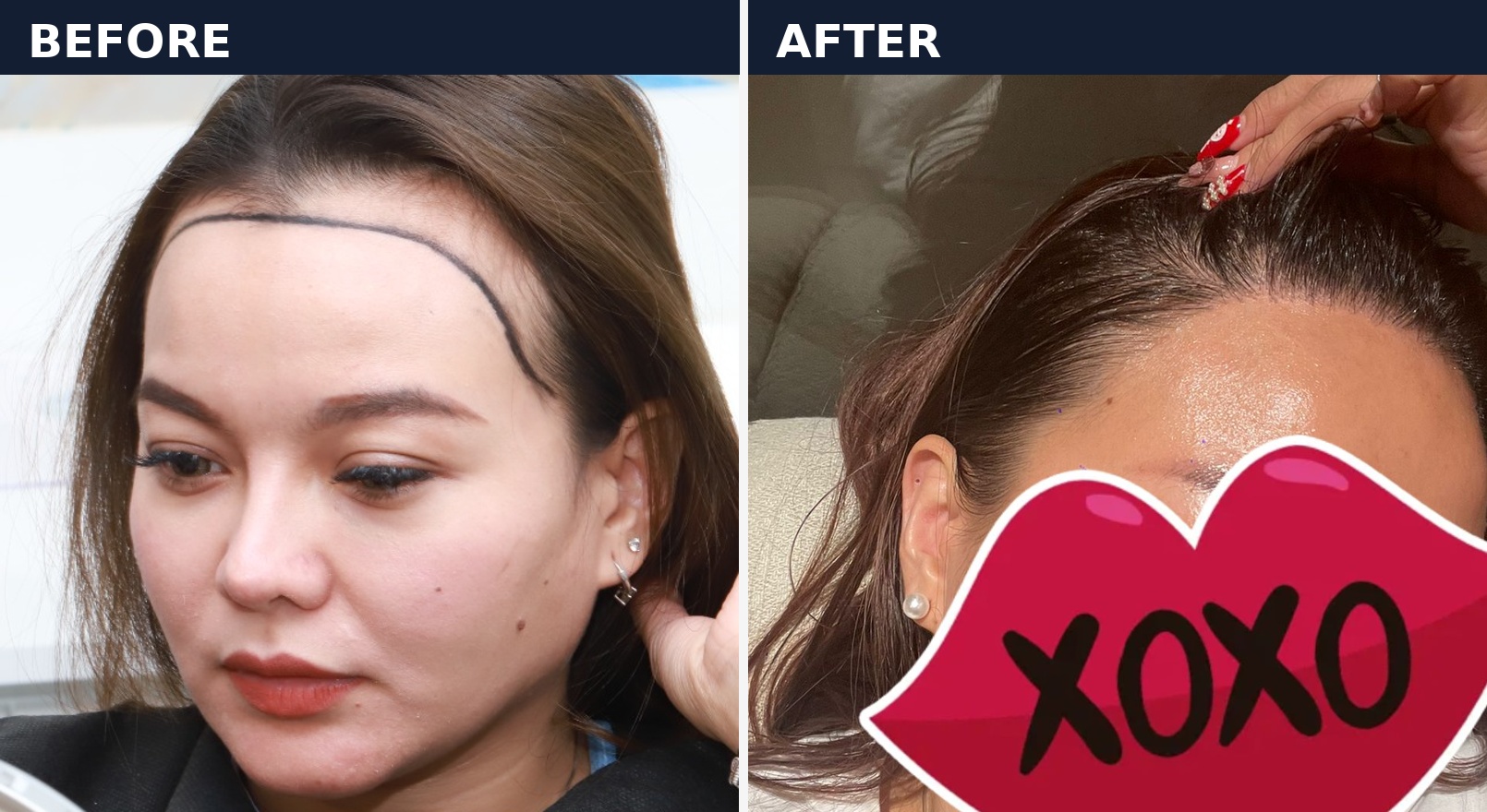 Before after pasien wanita dengan perbaikan hairline di Sule Hair Clinic