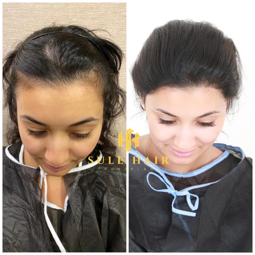 Before and after pasien wanita di Sule Hair Clinic