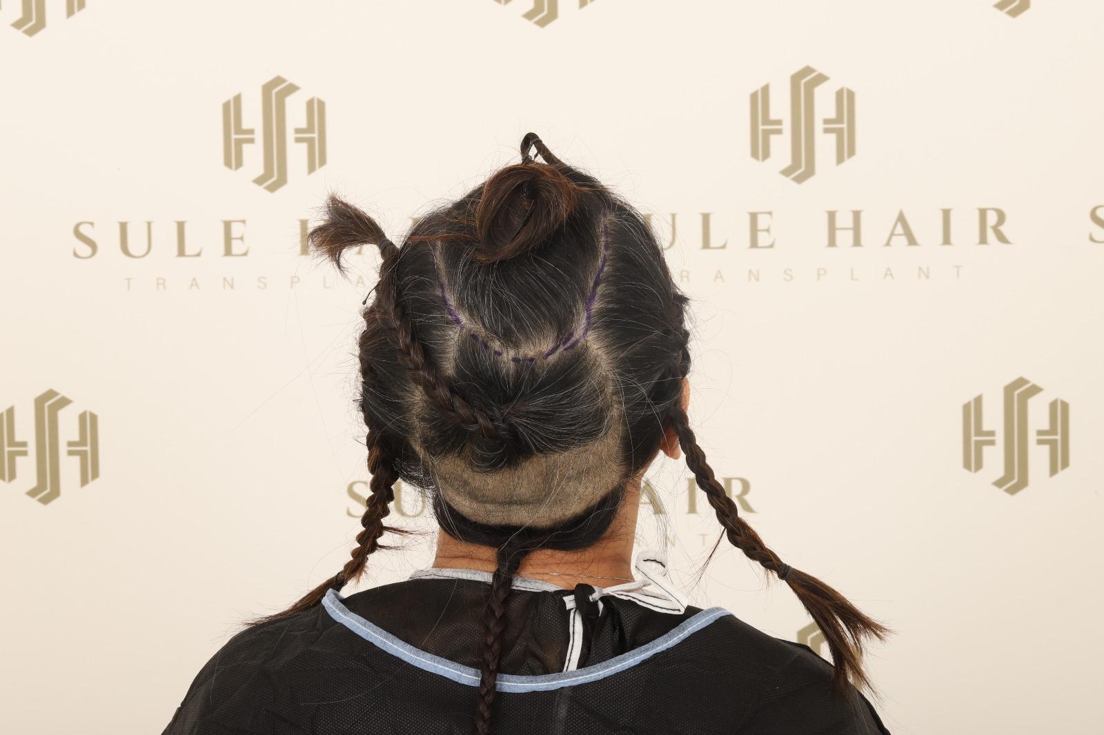 Persiapan donor area pasien wanita di Sule Hair Clinic