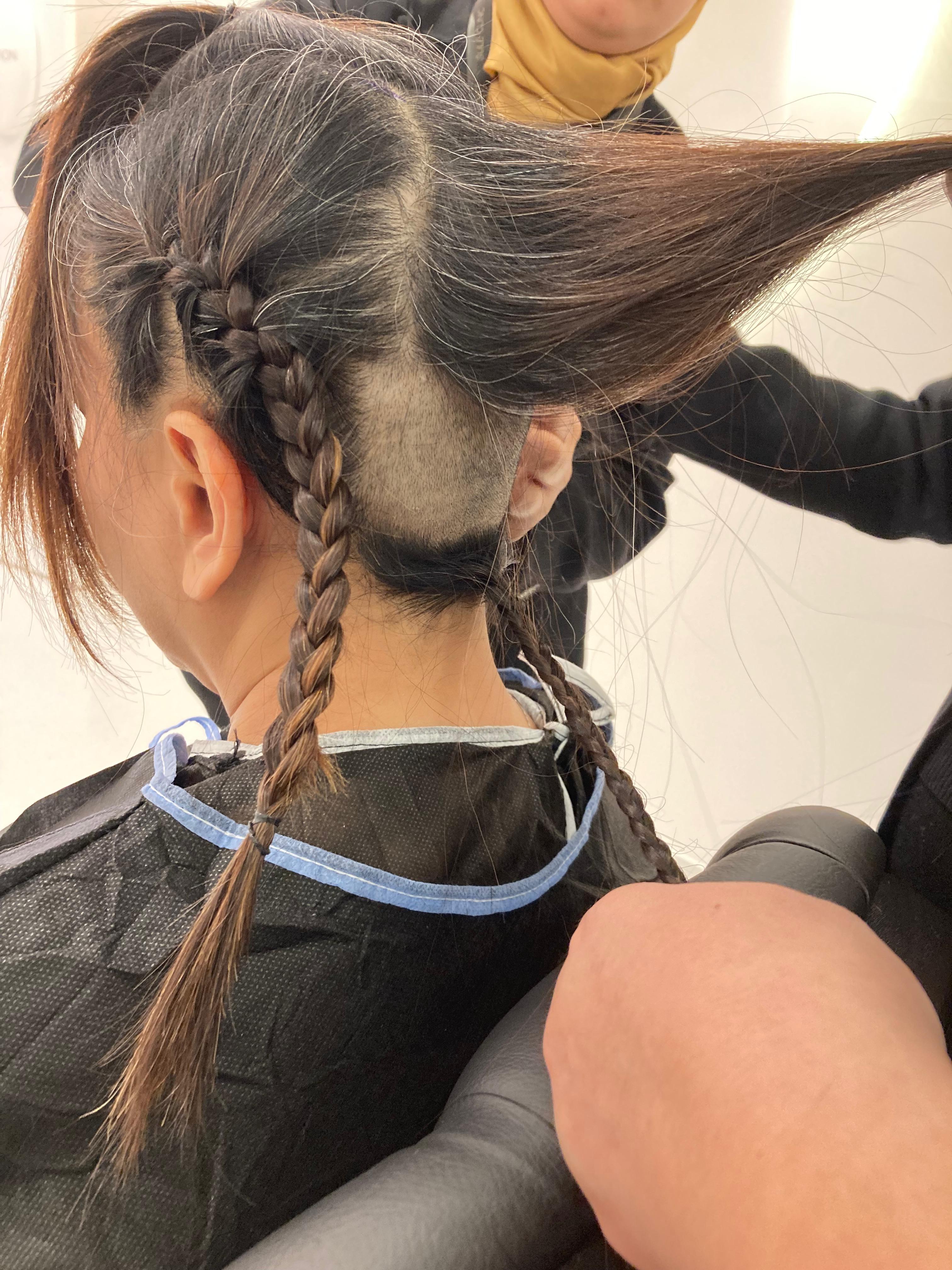 Detail area donor pasien wanita saat proses tindakan di Sule Hair Clinic